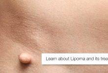 1 Learn about Lipoma and its treatment