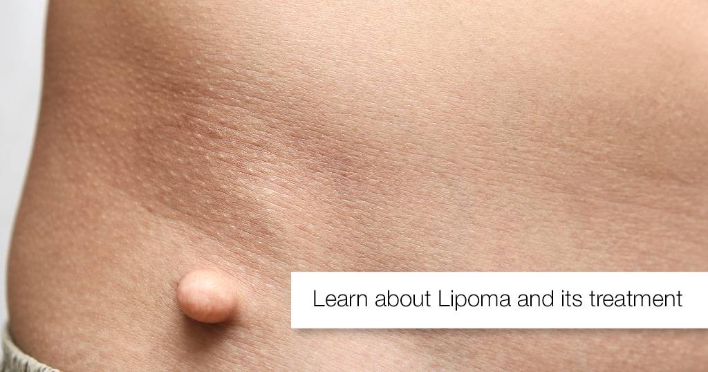 1 Learn about Lipoma and its treatment