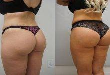 brazilian butt lift bbl