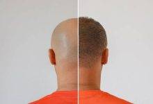 5 Hair Loss Conditions a Hair Transplant Can Fix