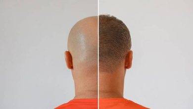 5 Hair Loss Conditions a Hair Transplant Can Fix