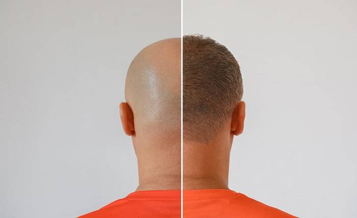 5 Hair Loss Conditions a Hair Transplant Can